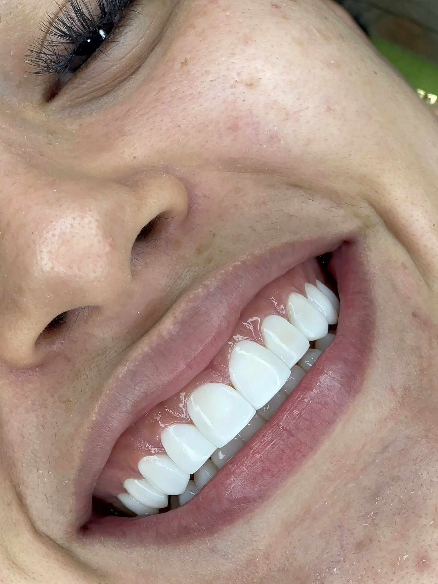 Blanqueamiento dental