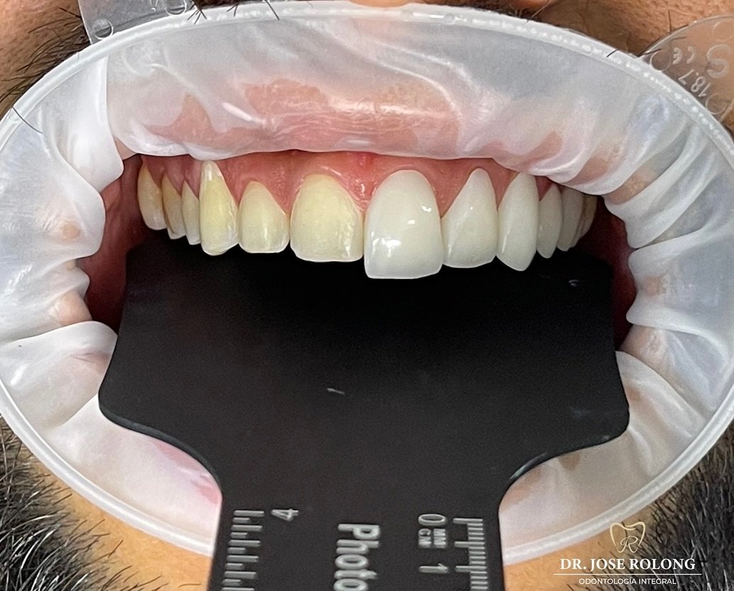 Carillas dentales - resultado final